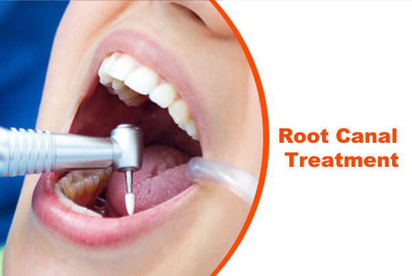 Root Canal Treatment (RCT)