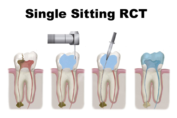 Single Sitting RCT