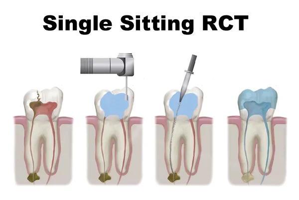 Single Sitting RCT