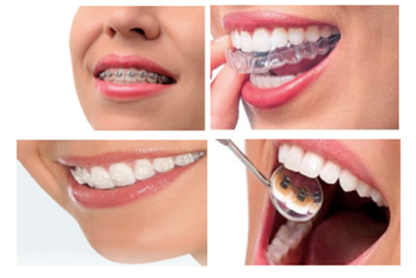 Braces (Orthodontic)
