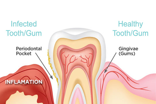 Treatment of All Gums Diseases