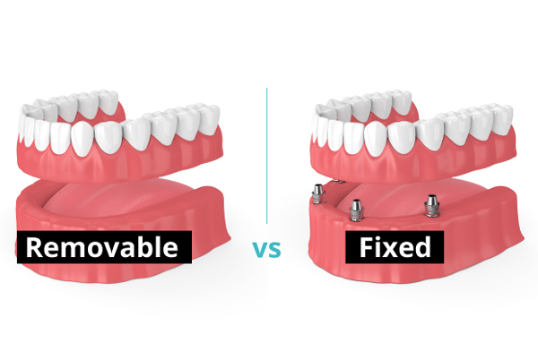 Fixed and Removable Teeth