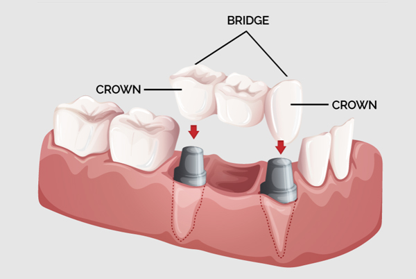 Crown and Bridges