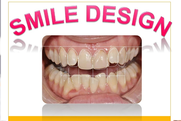 Smile Designing