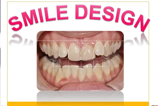 Smile Designing