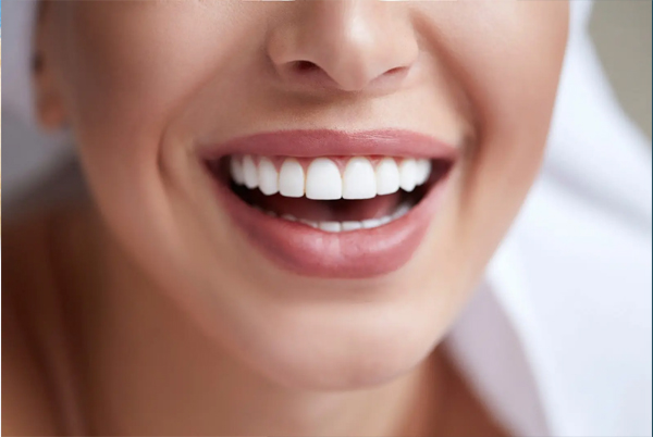 Veneer