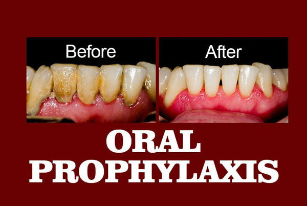 Oral Prophylaxis (Cleaning)